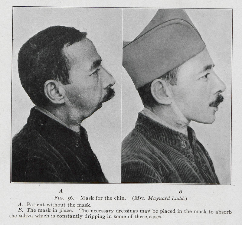 Injured veteran wearing a prosthetic mask, from Plastic surgery: its principles and practice by John Staige Davis (1919)