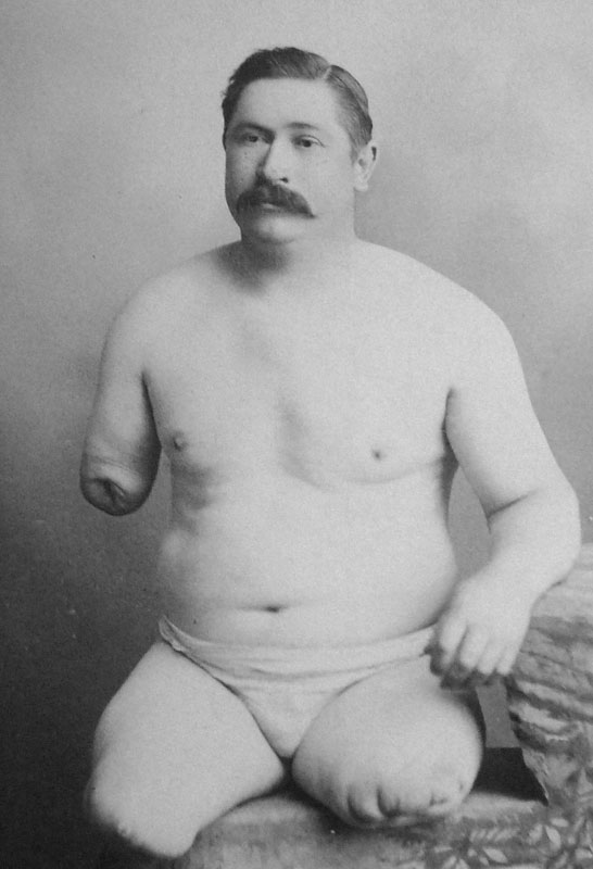 J. McKnight, the second patient to have survived a simultaneous triple amputation performed by James Buckner Luckie (c.1870)
