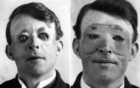 Walter Yeo before and after undergoing plastic surgery (c.1917)